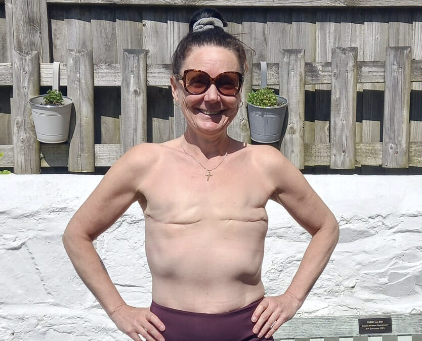 Colour photograph of a woman facing the camera standing topless. Her mastectomy scars are showing to raise the profile of Lobular Breast Cancer