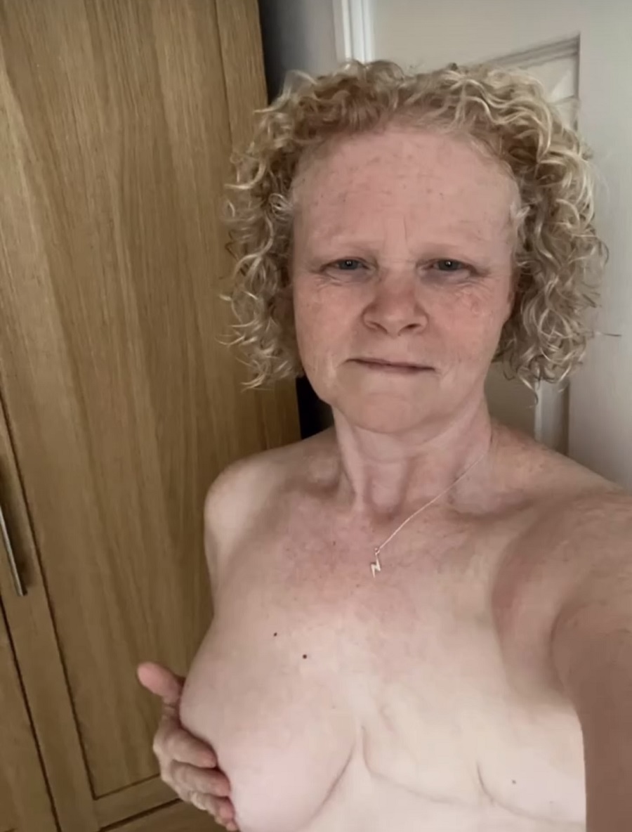 Lisa with a breast removed