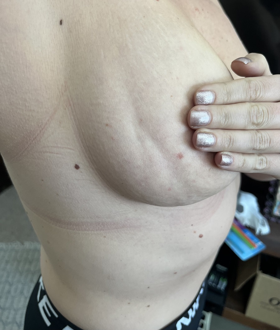 The indent on Kristen's breast